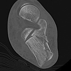 Calcaneal Fracture Axial CT